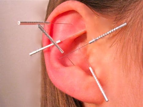 Ear Acupuncture using fine Acupuncture needles