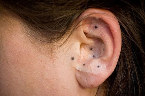 Ear Acupuncture using pellets